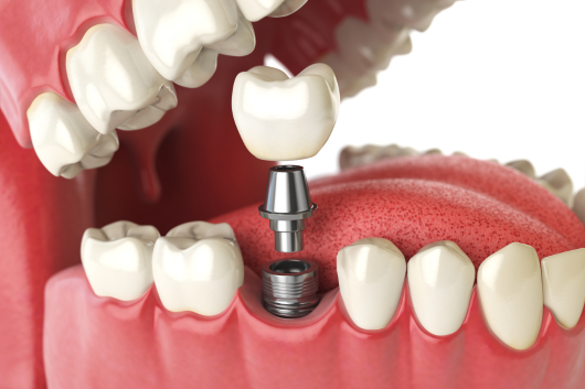 dental implants - 1