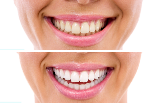 teeth whitening - 1 (1)